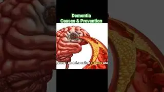 Understanding Dementia: Causes & Prevention Tips #alzheimer #dementiaprevention #braingames #health
