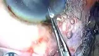 Iris Prolapse Phaco 3.1 Complications