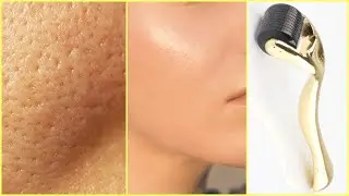 Derma Roller ব্রনের গর্ত, Dark circles, ব্রন , accident spot, সেলাইয়ের দাগ,ক্ষতের দাগ, দূর করে