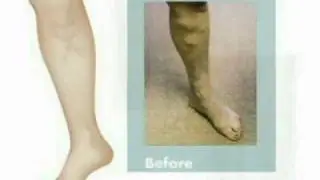 Varicose Veins (Part 2) Signs Symptoms Diagnosis Treatment