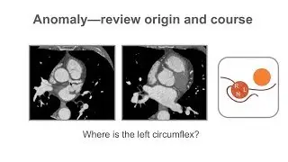 Describing coronary artery anomalies.