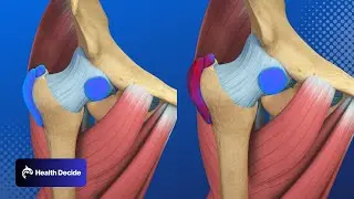 Hip Pain? Trochanteric (Hip) Bursitis - 3D Animation
