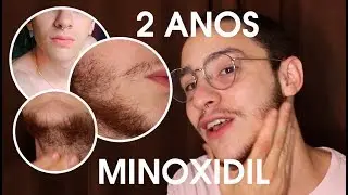 Diário da Barba: APÓS 2 ANOS COM MINOXIDIL  | Danilo Lourenço