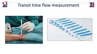 Transit Time Flow Measurement (TTFM) Explained by Dr. Meyer