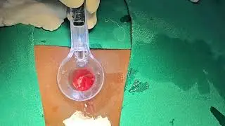 PROCTOSCOPY|DR.SACHIN GUPTA -+919419135050 