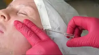 Подтяжка кожи лица нитями - нижняя и средняя треть