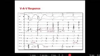 Narrow Complex Tachcardia   Dr  Mohamed Adam