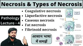 Necrosis and Types of Necrosis in Hindi, Pathology Lecture Notes, Bsc Nursing, GNM, MLT, Pharmacy