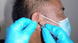 This is How to Clean Elderly Man's Ear
