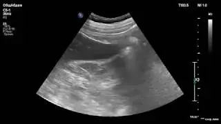 УЗИ правой почки. Злокачественная опухоль. Ultrasound diagnostics. Kidney. Cancer.
