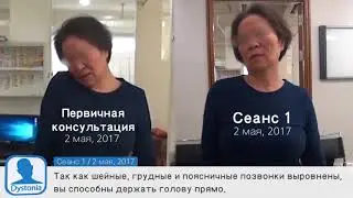 Спастическая кривошея