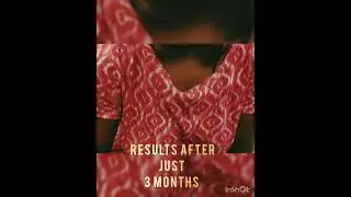 TESTIMONIAL OF OUR PATIENT AFTER TUMMY TUCK AND THIGH LIPOSUCTION SURGERY UNBELIEVABLE RESULTS !