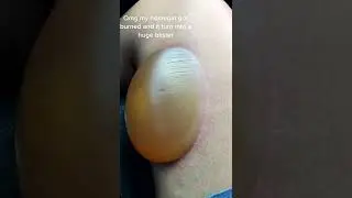Black head removal on face - Blackheads on back treatment