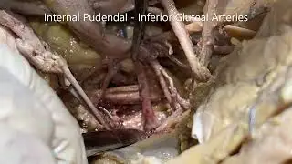 UMBILICAL LIGAMENTS and INTERNAL ILIAC ARTERY Branches with Clinical Aspects – Sanjoy Sanyal