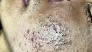 The Ultimate Blackhead Removal Technique: 8min of Pure Satisfaction