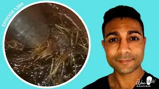 1,388 - Cotton Swab Impacted Dark Matted Ear Wax Removal