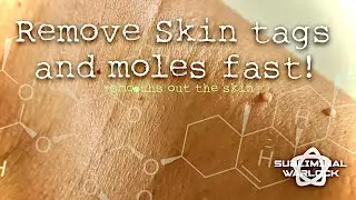 Remove Skin Tags, Moles and Birthmarks Fast!