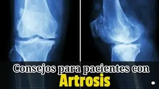consejos para pacientes con artrosis
