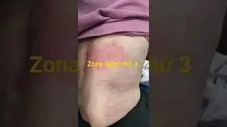 Zona cần được chẩn đoán và điều trị sớm để tránh biến chứng về sau