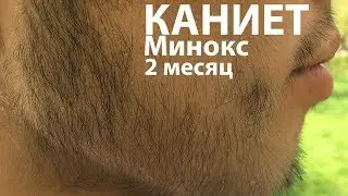 Миноксидил. Каниет хочет бороду. 2 месяц