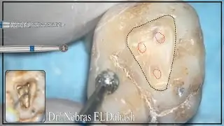 Upper Molar Access cavity preparation
