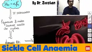 Sickle Cell Anaemia Pathology & concepts in Hindi #medicine #neet_pg_2022 #inicet #robbins_pathology