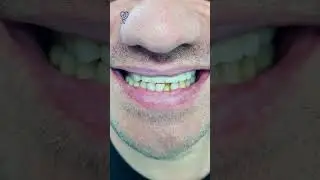 Мне больше не больно и не страшно. Не нужно терпеть боль. Имплантация зубов.