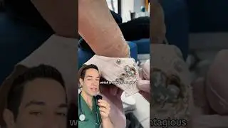 Doctor Reacts: extreme foot warts