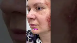 Лазерный пилинг, шлифовка, реабилитация #косметологкраснодар #врачкосметолог #юлияосташевская