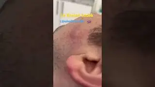Massive face cyst 