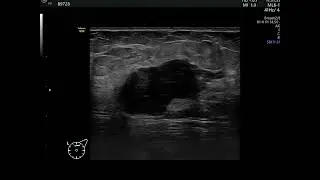 breast cancer(malignant RI index)