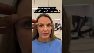 Amazing 6 Month #facelift transformation! 😍 #shorts