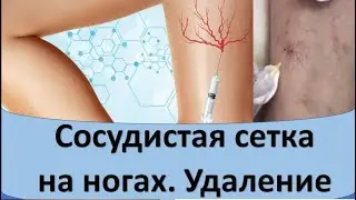 Сосудистая сетка на ногах. Удаление