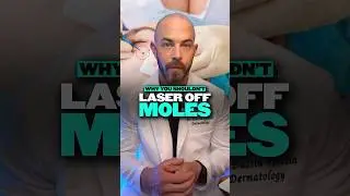 Should you laser your moles? Derm explains why this is a BAD idea! 