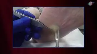 WCW: Removing Early Callus Formation of a Diabetic Foot Ulcer