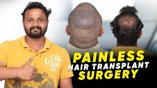 Hair Transplant in Rohtak | Best Results & Cost of Hair Transplant in Rohtak