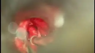 Stapedotomy