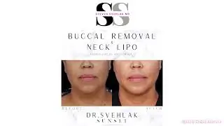 Snatched by Svehlak - Cosmetic Procedures with Local Anesthesia #snatchedbysvehlak