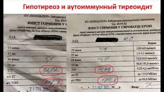 Гипотиреоз, аутоиммунный тиреоидит отзыв