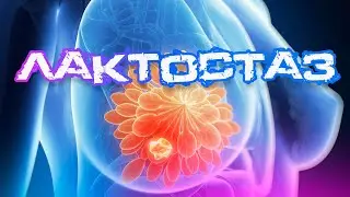 Застой молока (Лактостаз): что делать? Скорая помощь кормящей маме