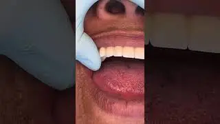 Comfortable full mouth implants zirconia!   Dr,John Vargas in New York