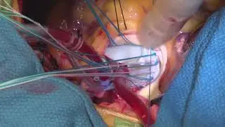 Aortic Valve Replacement  Step by Step (Step 6 of 7)