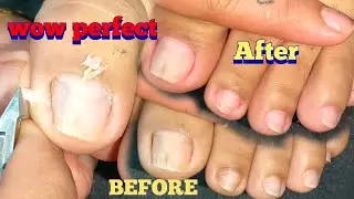 PEDICURE RELIEF ON PINCER INGROWN TOENAIL THAT HURTS 💚