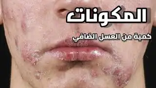 أبسط طريقة علاج حب الشباب