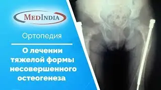 Несовершенный остеогенез - госпиталь "Фортис" (Индия)
