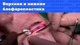 Операция: Верхняя и нижняя блефаропластика при периорбитопластике