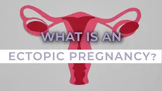ECTOPIC PREGNANCY: SYMPTOMS, CAUSES AND TREATMENT
