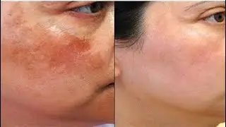 freckles treatment results || freckles treatment at home || how to get rid freckle