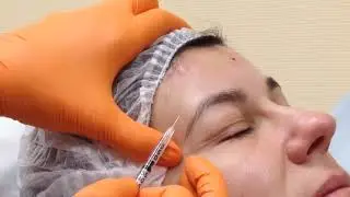 Меди-лайт удаление морщин ботоксом; верхняя часть лица