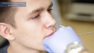 Полипы в носу. Хронически полипозный риносинусит.